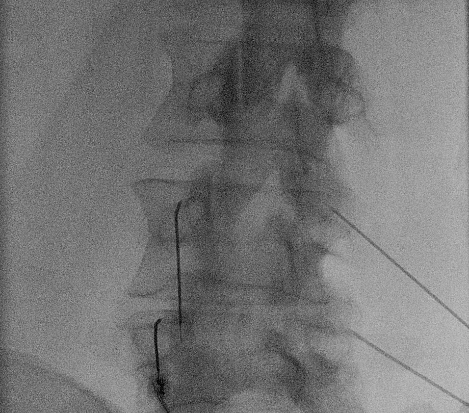 X-ray of the lower spine during facet joint denervation, showing thin radiofrequency needles placed beside the small nerves that supply the facet joints