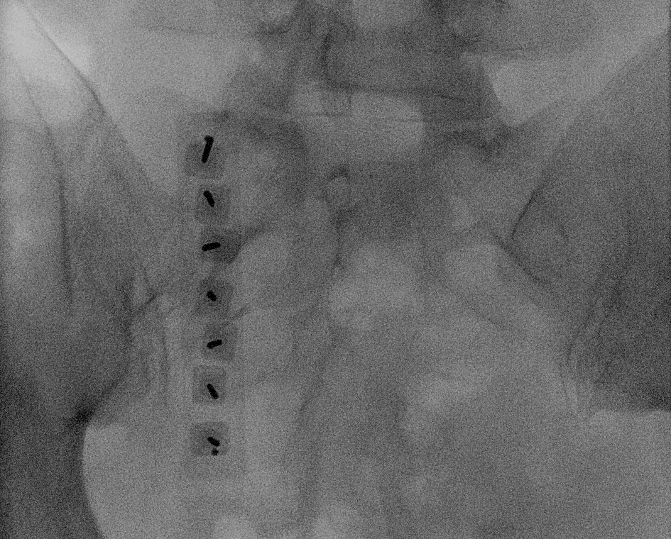 X-ray of the pelvis during sacroiliac joint denervation, showing a line of treatment points beside the sacrum